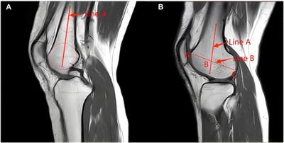 Increased lateral femoral condyle ratio measured by MRI is associated with higher risk of solitary meniscus injury